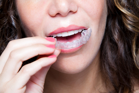 Image of a woman putting in Invisalign clear braces.